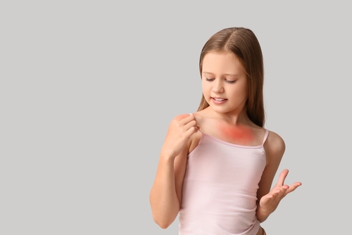Eritemi Solari nei Bambini: Come Alleviarli con i Prodotti più Efficaci