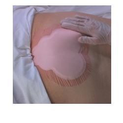 MEDICAZIONE IDROCELLULARE ADESIVA STERILE CONFORMATA PER LA REGIONE SACRALE ASSORBENTE IN SCHIUMA DI POLIURETANO ALLEVYN SACRUM 22,5X22,1CM 10PZ - Farmastop